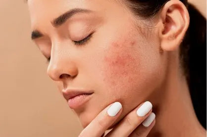 Quelles pierres choisir pour apaiser les irritations cutanées ?